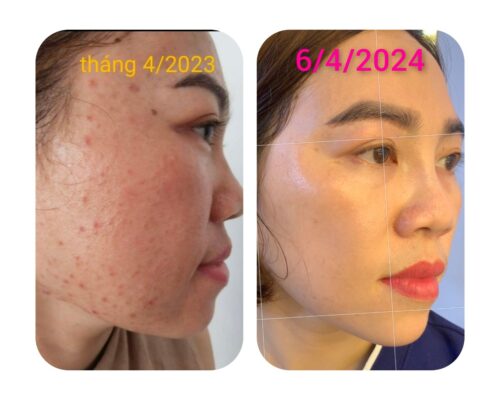 Khách hàng điều trị Nám không bong bằng công nghệ Nano hướng đích